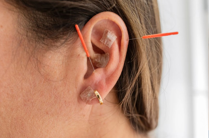 Acupuntura en Bogotá-Euritmia